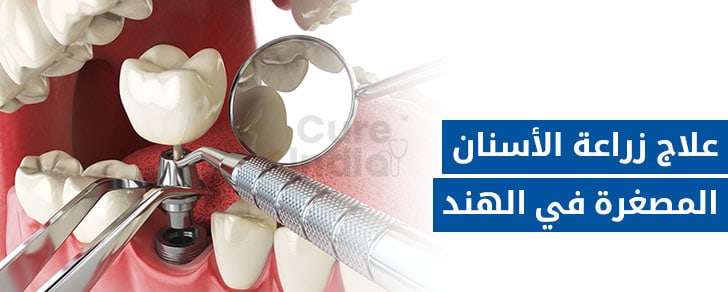زراعة الاسنان المصغر \ Mini Dental Implants